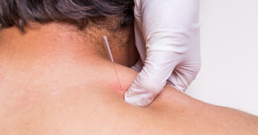 dry needle inserted into shoulder