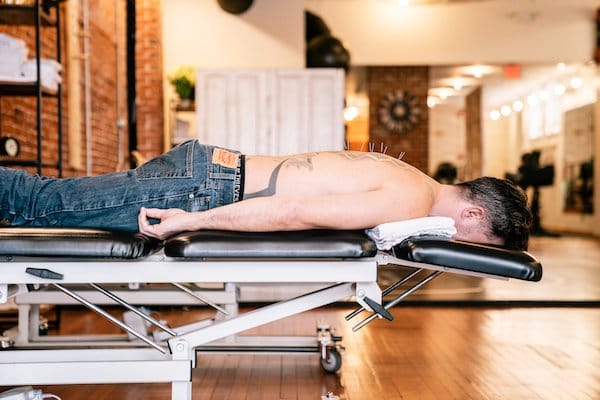 shirtless man lying on therapy table with dry needles in his back