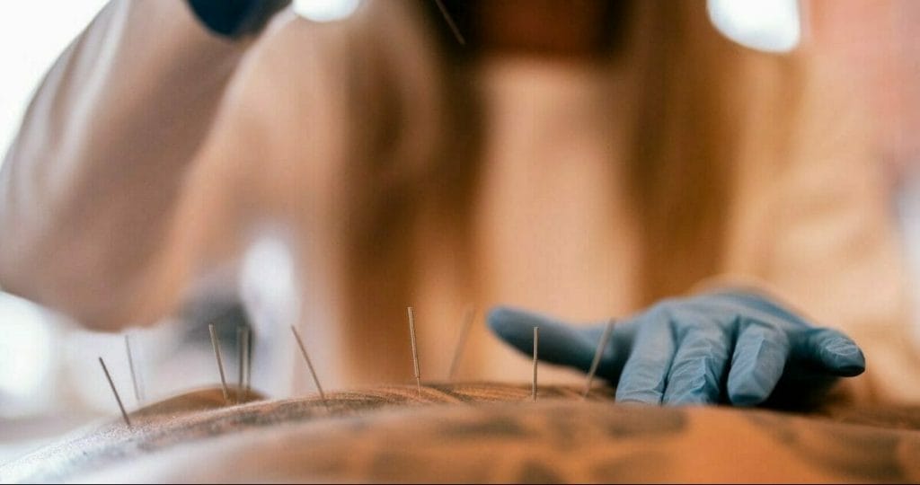 a therapist performing a dry needling at the back of the man with tattoo