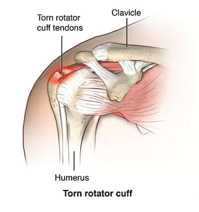 anatomy of shoulder graphic showing torn rotator cuff tendons near clavicle and humerus