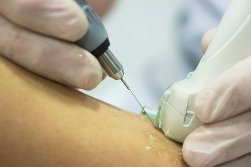 dry-needling-tendonitis dry-needling-tendonitis