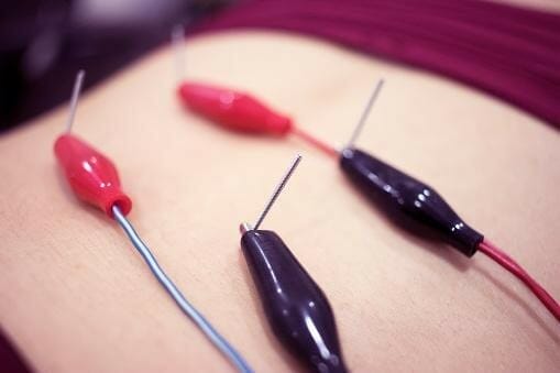 dry needling at the back of the patient