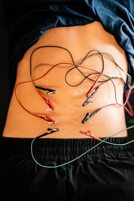 Dry Needling Electrical Stimulation (E-Stim) Treatment: Manage Neck &  Shoulder Pain 